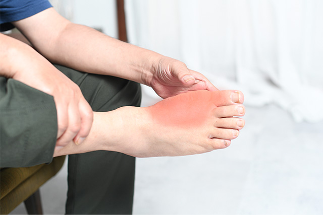 高尿酸血症（痛風）